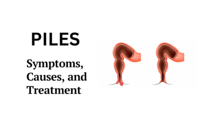 Haemorrhoids (Piles) causes, symptoms, treatment and tips