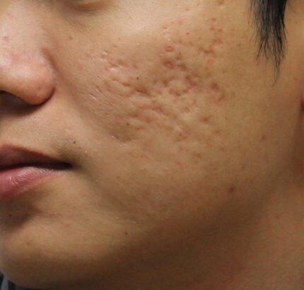 how to remove acne scars naturally in a week