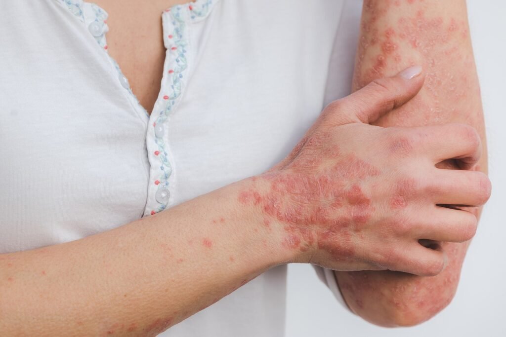 Psoriasis: Symptoms, Treatment, and Lifestyle Tips