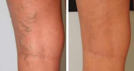 Varicose Veins causes symptoms treatment and prevention