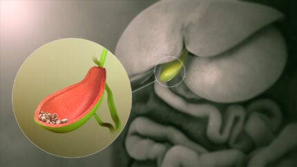 Gallbladder stones symptoms causes types diet treatment