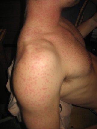 skin rashes causes symptoms treatment