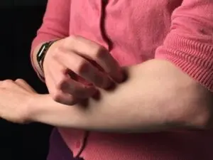 itching or hives